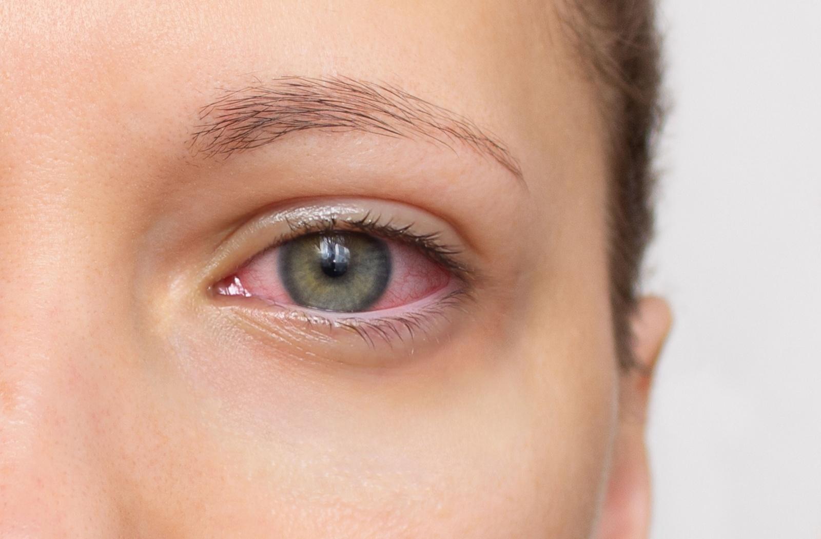 A close up of a person while red irritated eyes caused by dry eye.